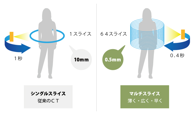 64列マルチスライスCTとは